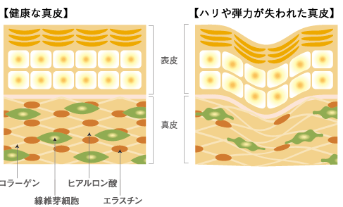 健康な真皮とトラブルのある真皮のイメージ