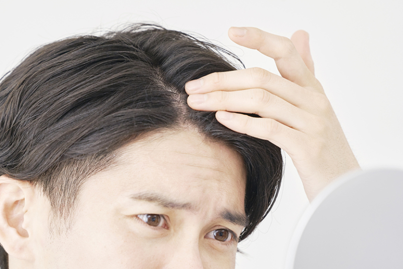 薄毛の主な原因は？薄毛にまつわる疾患や今からできる薄毛対策を解説の写真