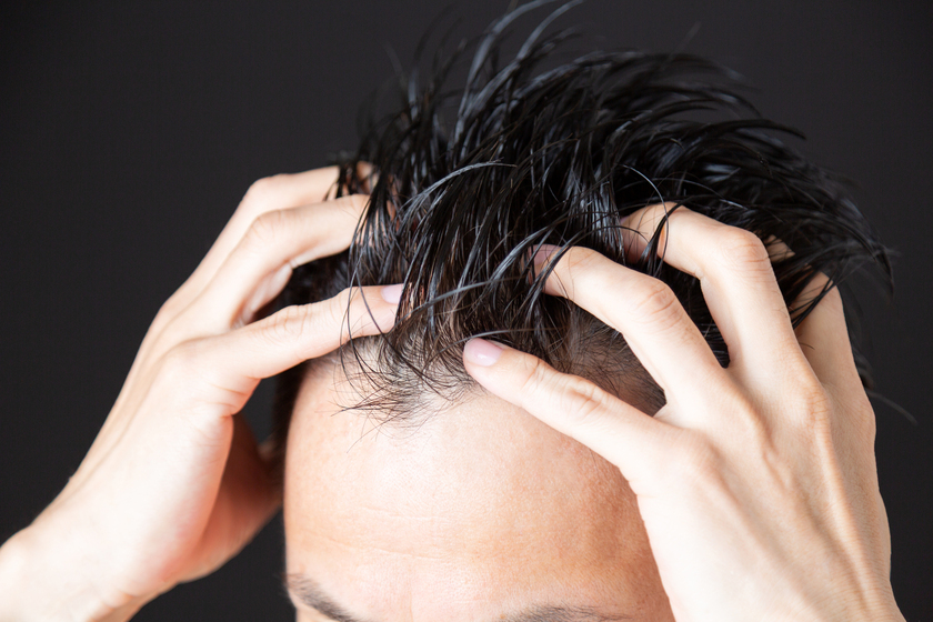 男性の頭皮の画像